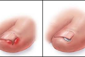 Kuku kaki sering membusuk? Itu namanya cantengan. Begini Cara mencegah dan penyebabnya.